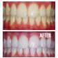 Blanqueamiento dental  con luz led -uso casero FloridaLabs - 3