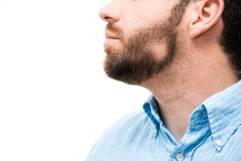 alopecia estres barba parches revertir